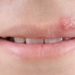 SOS-Hilfe: Was tun bei Herpes?